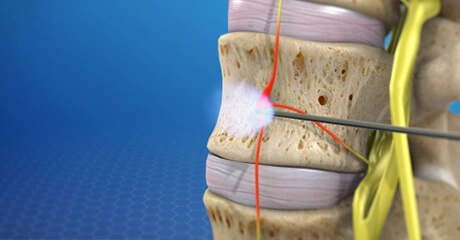 Nerve root block injecting in the spinal cord